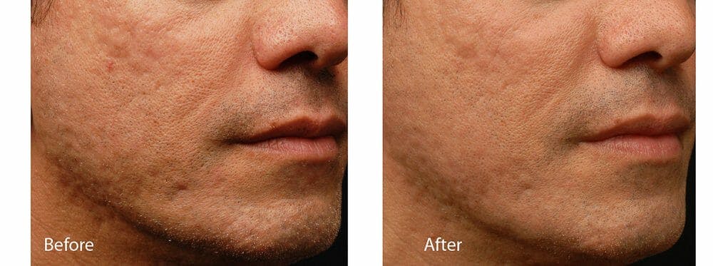 Acne & Acne Scars