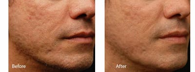 Acne Before & After Gallery - Patient 53590655 - Image 1