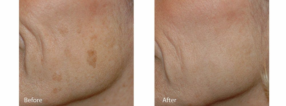 Melasma