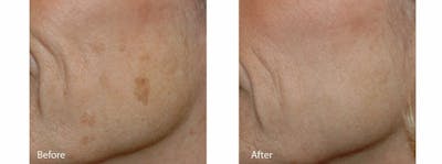 Age Spots and Melasma Before & After Gallery - Patient 47432433 - Image 1