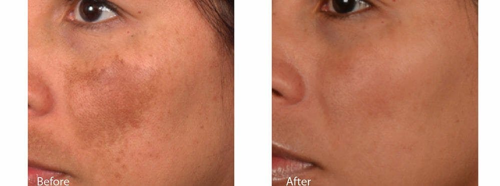 Melasma