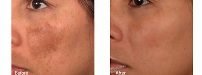 Age Spots and Melasma Before & After Gallery - Patient 47432434 - Image 1