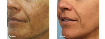Age Spots and Melasma Gallery - Patient 47432437 - Image 1