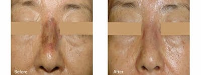 Age Spots and Melasma Before & After Gallery - Patient 53599616 - Image 1