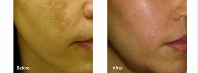 Age Spots and Melasma Gallery - Patient 47432454 - Image 1