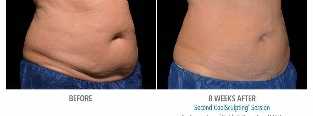 CoolSculpting