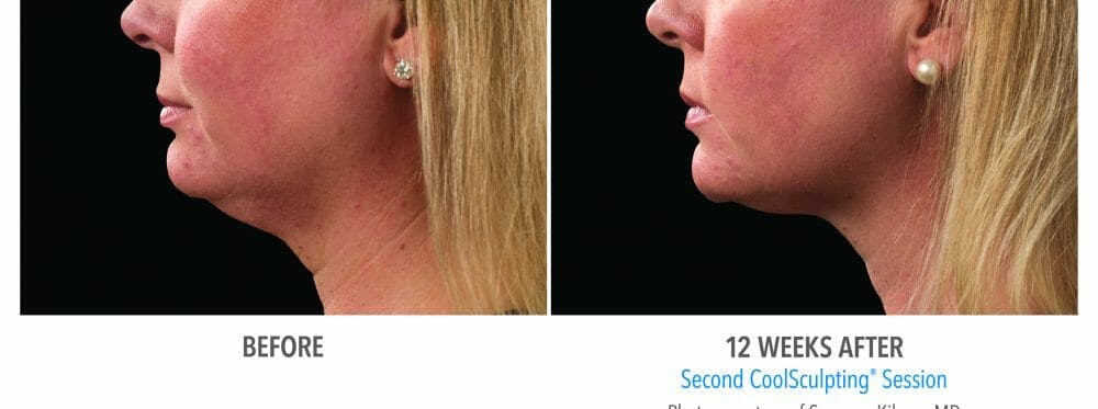 CoolSculpting