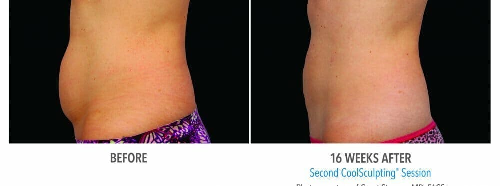 CoolSculpting