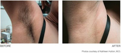Laser Hair Removal Before & After Gallery - Patient 47432597 - Image 1
