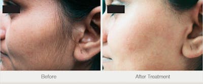 Laser Hair Removal Before & After Gallery - Patient 47432599 - Image 1