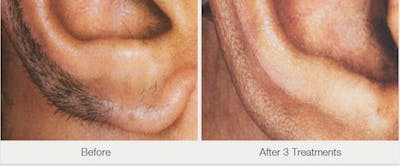 Laser Hair Removal Before & After Gallery - Patient 53599707 - Image 1