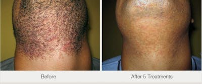 Laser Hair Removal Before & After Gallery - Patient 47432605 - Image 1
