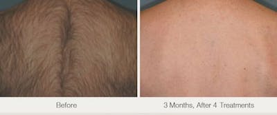 Laser Hair Removal Before & After Gallery - Patient 53599710 - Image 1