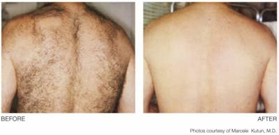 Laser Hair Removal Before & After Gallery - Patient 47432610 - Image 1