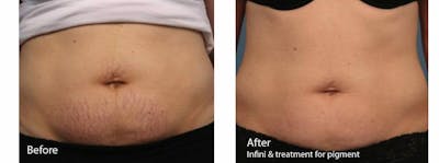 Stretch Mark Removal Before & After Gallery - Patient 47432638 - Image 1