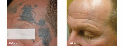 Tattoo Removal Before & After Gallery - Patient 53599753 - Image 1