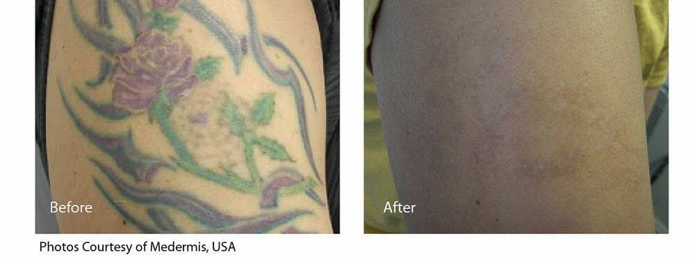 Tattoo Removal