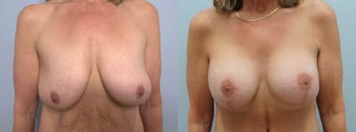 Breast Lift With Implants Before & After Gallery - Patient 47434203 - Image 1