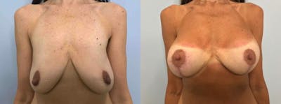 Breast Lift With Implants Before & After Gallery - Patient 47434207 - Image 1