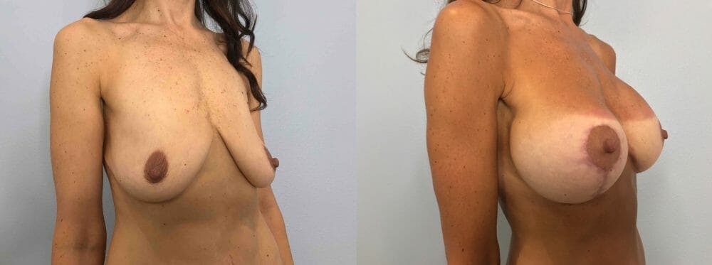 Breast Lift With Implants Gallery - Patient 47434207 - Image 2