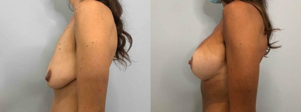 Breast Lift With Implants Gallery - Patient 47434207 - Image 5
