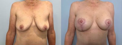 Breast Lift With Implants Before & After Gallery - Patient 47434208 - Image 1
