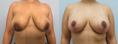 Breast Lift With Implants Before & After Gallery - Patient 47434210 - Image 1