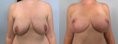 Breast Lift With Implants Before & After Gallery - Patient 47434211 - Image 1