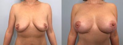 Breast Lift With Implants Before & After Gallery - Patient 47434213 - Image 1