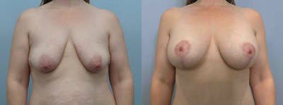 Breast Lift With Implants Before & After Gallery - Patient 47434216 - Image 1