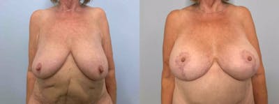 Breast Lift With Implants Before & After Gallery - Patient 47434217 - Image 1