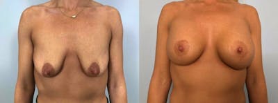 Breast Lift With Implants Before & After Gallery - Patient 47434220 - Image 1