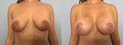 Breast Lift With Implants Before & After Gallery - Patient 47434225 - Image 1