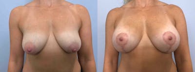 Breast Lift With Implants Before & After Gallery - Patient 47434227 - Image 1