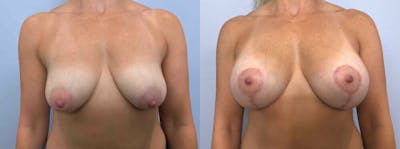 Breast Lift With Implants Before & After Gallery - Patient 47434227 - Image 1