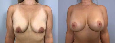 Breast Lift With Implants Before & After Gallery - Patient 47434229 - Image 1