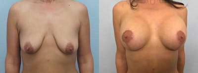 Breast Lift With Implants Before & After Gallery - Patient 47434234 - Image 1