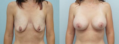 Breast Lift With Implants Before & After Gallery - Patient 47434236 - Image 1