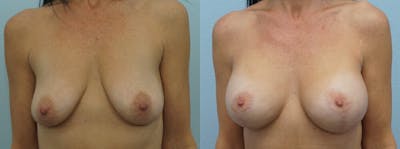 Breast Lift With Implants Before & After Gallery - Patient 47434237 - Image 1