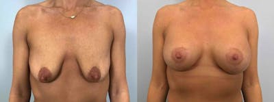 Breast Lift With Implants Before & After Gallery - Patient 47434371 - Image 1