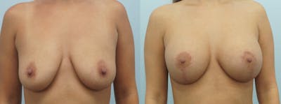 Breast Lift With Implants Before & After Gallery - Patient 47434380 - Image 1