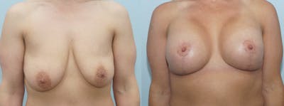 Breast Lift With Implants Before & After Gallery - Patient 47434386 - Image 1
