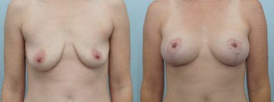Breast Lift With Implants Before & After Gallery - Patient 47434392 - Image 1