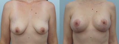 Breast Lift With Implants Before & After Gallery - Patient 47434395 - Image 1