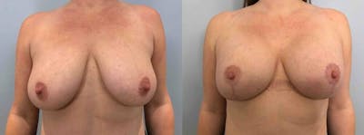 Breast Lift With Implants Before & After Gallery - Patient 47434407 - Image 1