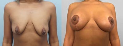 Breast Lift With Implants Before & After Gallery - Patient 47434409 - Image 1