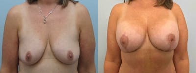 Breast Lift With Implants Before & After Gallery - Patient 47434414 - Image 1