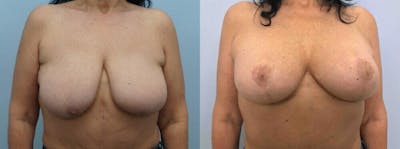 Breast Lift With Implants Before & After Gallery - Patient 47434424 - Image 1
