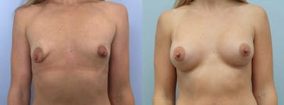 Breast Augmentation Before & After Gallery - Patient 48813365 - Image 1