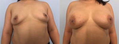 Breast Augmentation Before & After Gallery - Patient 48813374 - Image 1